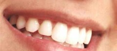 implantes-dentarios-rondonopolis-1371244528